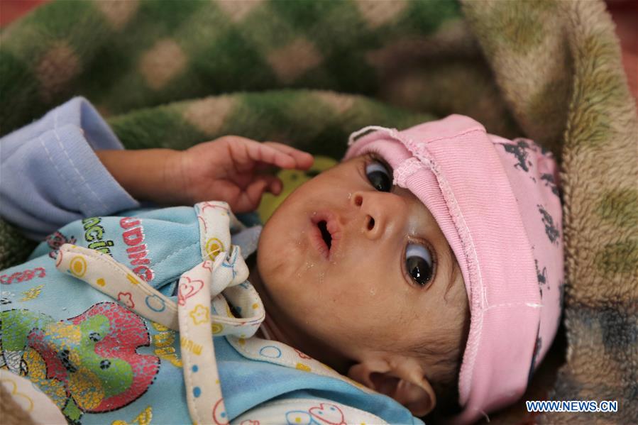 YEMEN-SANAA-CHILDREN-MALNUTRITION