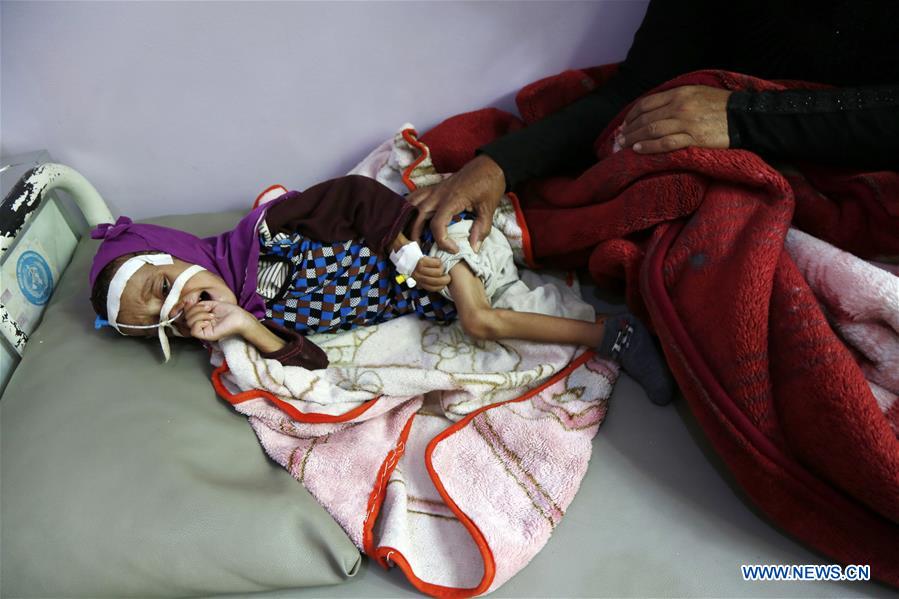 YEMEN-SANAA-CHILDREN-MALNUTRITION 